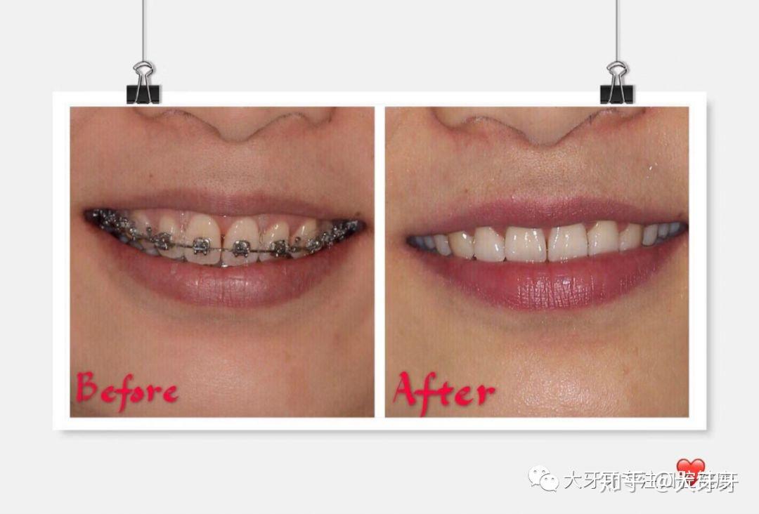 给人以兔牙的感觉,牙齿深覆合情况严重,上面的牙严重压低下排的牙齿