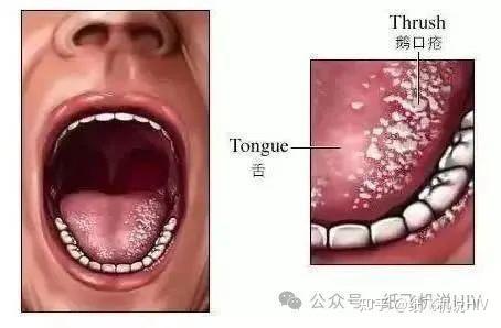 口腔溃疡大全图片图片