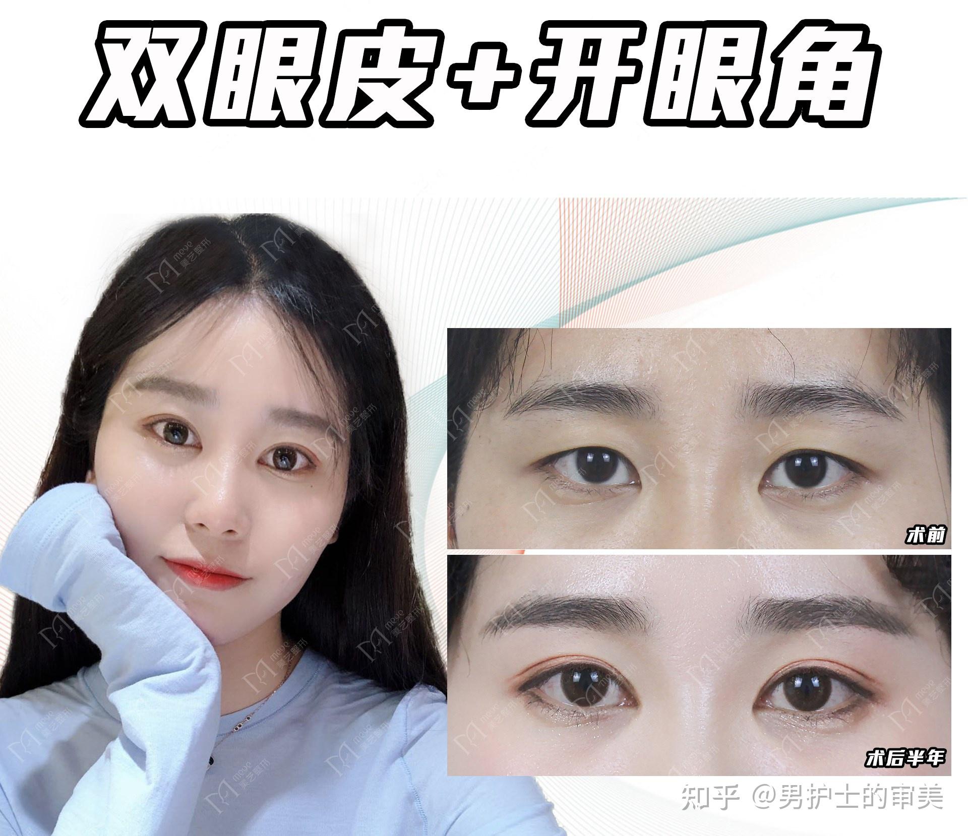 可以发一下你们开眼角的前后对比图吗？ - 知乎