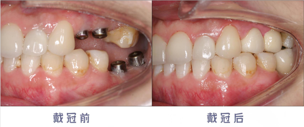 最大程度地恢复牙齿咀嚼功能种植牙可以恢复九成以上的咀嚼功能.