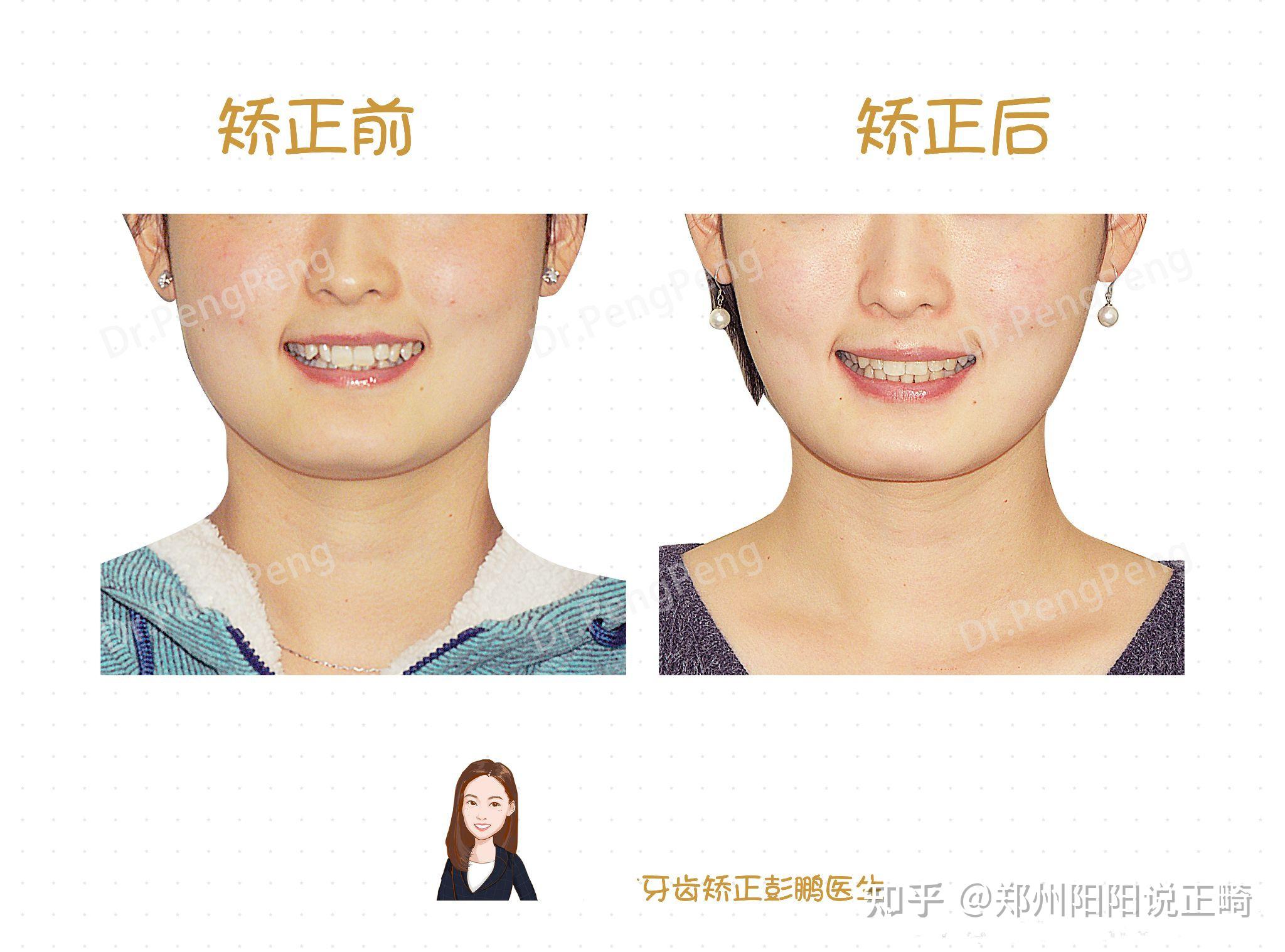 郑州牙齿矫正闭锁性深覆颌矫正案例