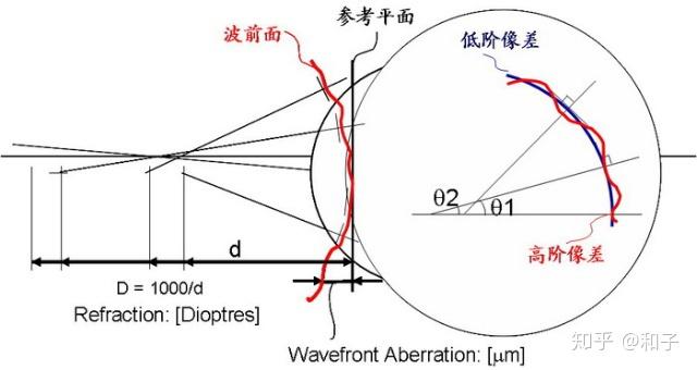 关于高阶像差,我做手术之前医生从来没有跟我提起过,我也就不太清楚