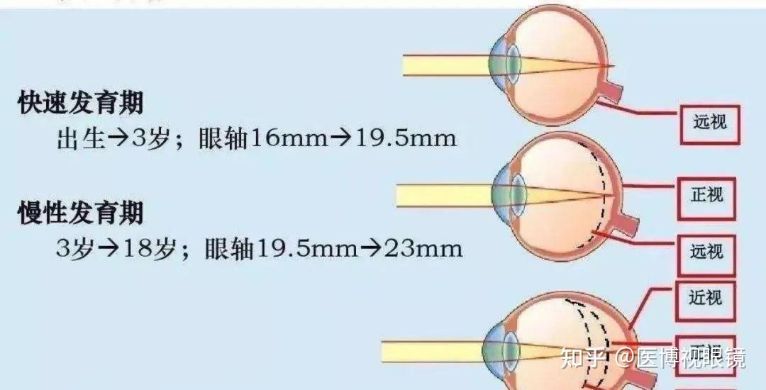 医博视眼镜什么是眼轴为什么要测眼轴