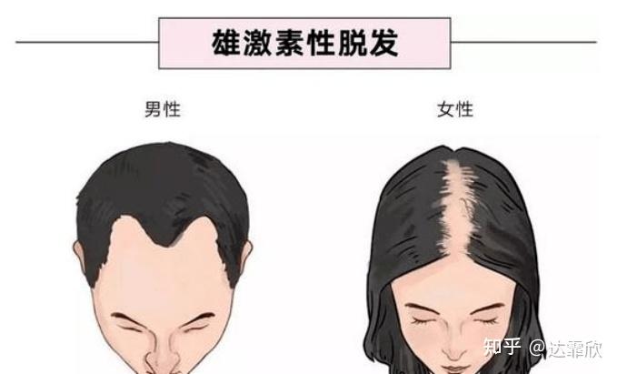 细软油秃发量危机别太担心,达霏欣教你如何科学使用米诺地尔生发 - 知乎