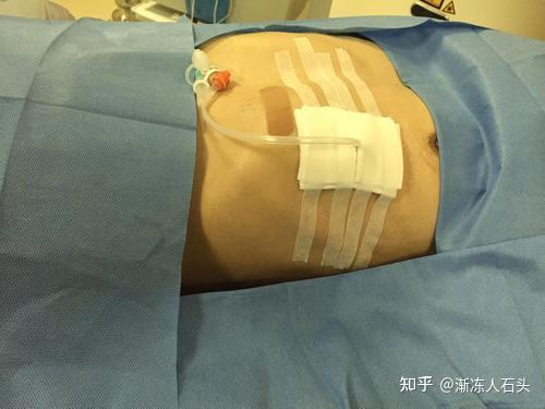 peg胃造瘘和球囊胃造瘘的区别?