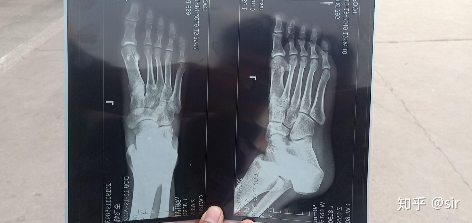 脚掌骨裂x光图片图片