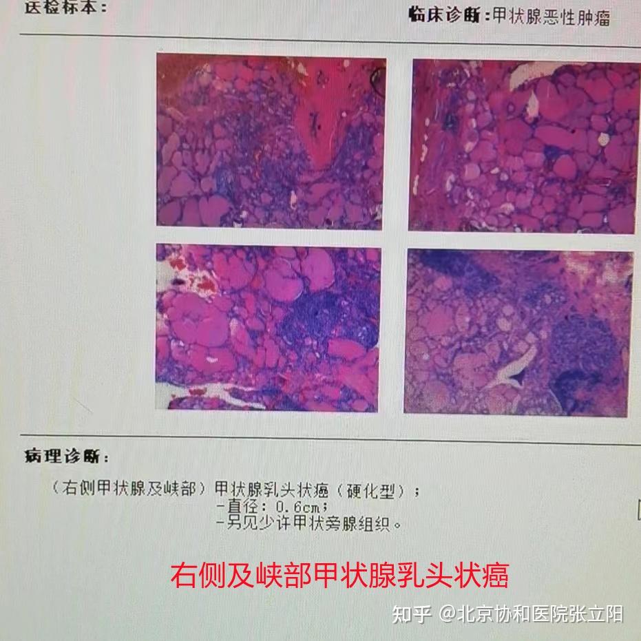 甲状腺结节自愈会癌变吗_甲状腺结节会自愈吗_甲状腺结节自愈会变小吗