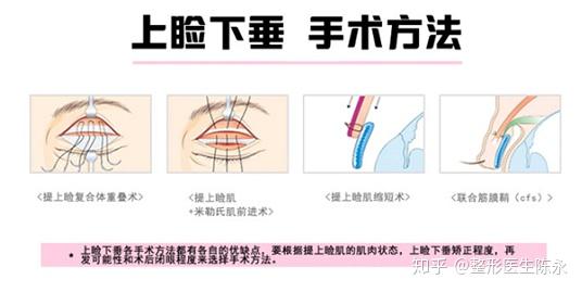 哪家美容医院好&杭州新清吟上睑提肌缩短术采用缩短上睑提肌来达到