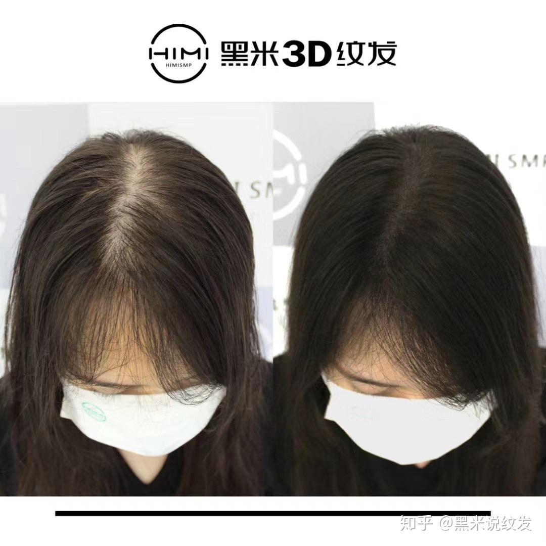 脱发时期很痛苦这项技术是广大发友的救星