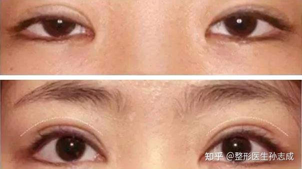 很多人内眼角形状比较圆钝,甚至完全看不到那块粉红色的肉肉(泪阜)