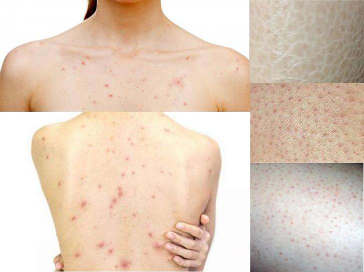 胸口上突然起了一块鸡皮肤(胸口上突然起了一块鸡皮肤的疙瘩)