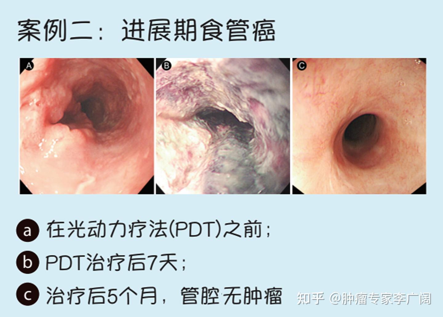 图说：食管癌的光动力治疗效果 - 知乎