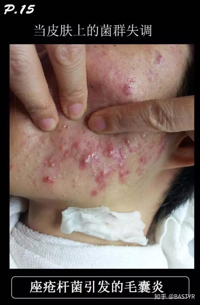 说说皮肤结构知识之皮脂膜