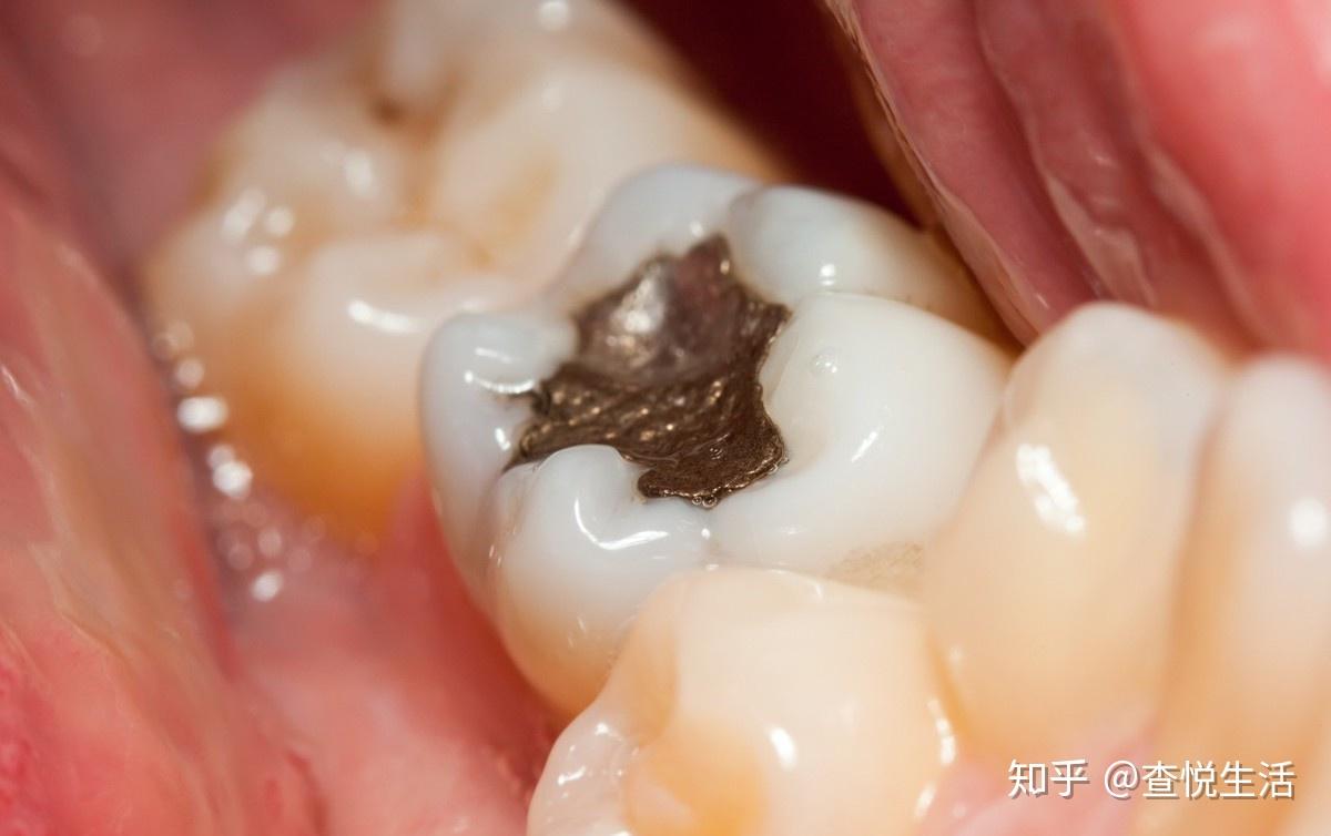 牙科临床上用的充填材料主要有三种,分别是复合树脂,玻璃离子,银汞