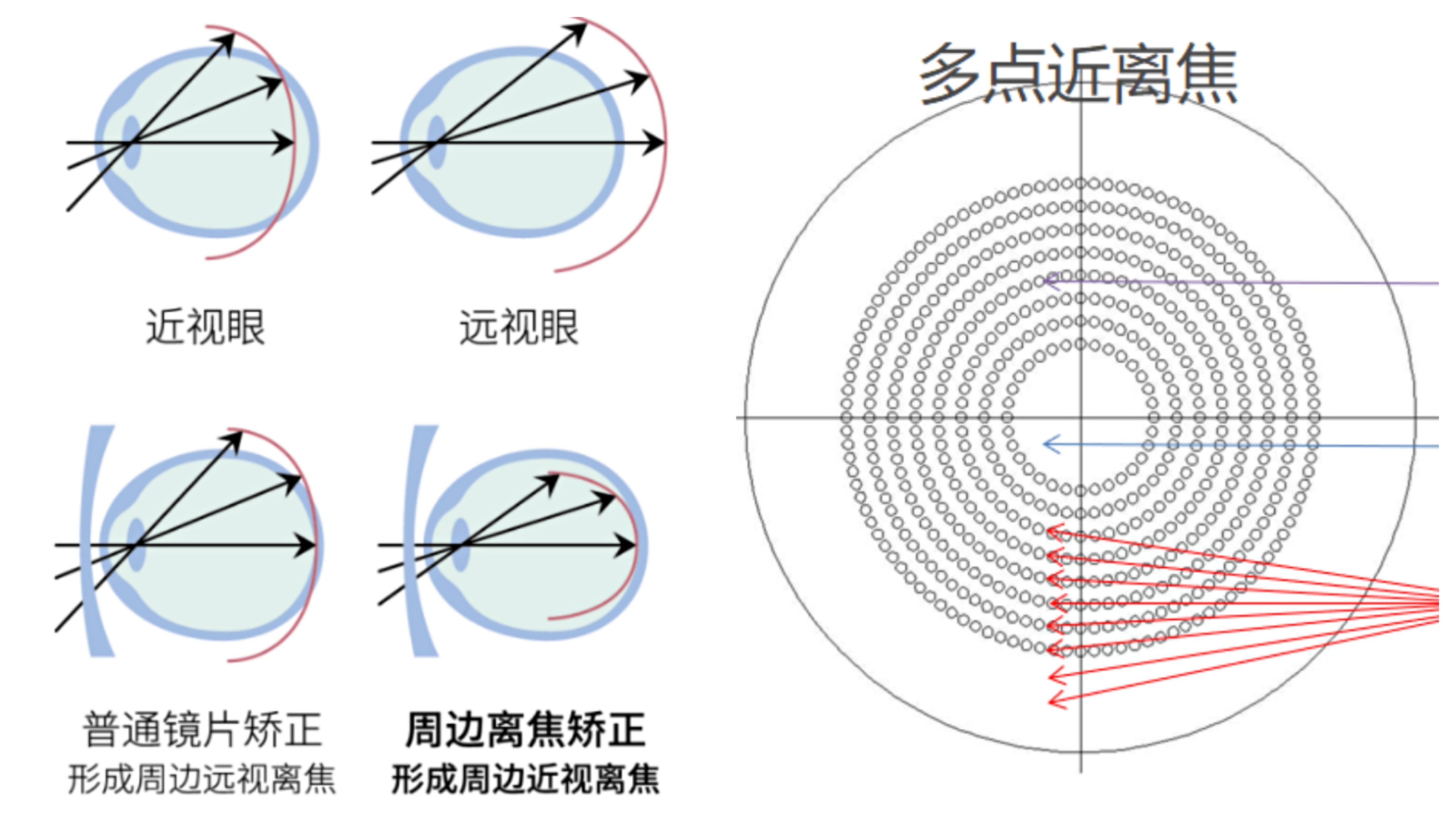 周边离焦眼镜和多点离焦眼镜还有传统眼镜有什么区别? - 知乎