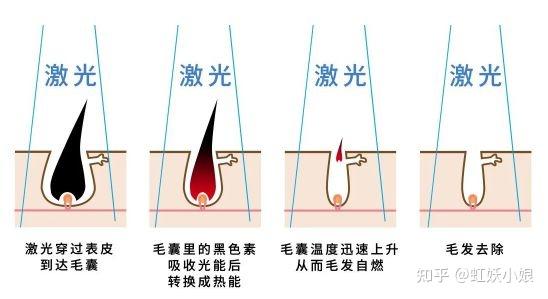 家用脱毛仪主要采用的是 ipl(强脉冲光)技术,原理和医美中的激光脱毛