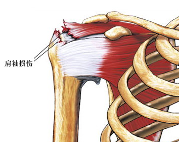 3分鐘動畫告訴你什麼是肩袖損傷