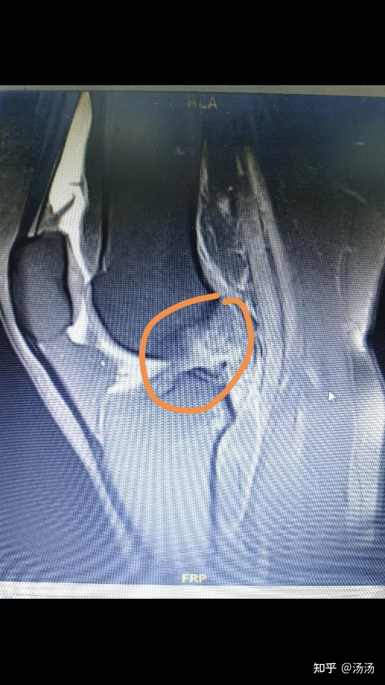 右膝前叉韧带损伤半月板三度损伤