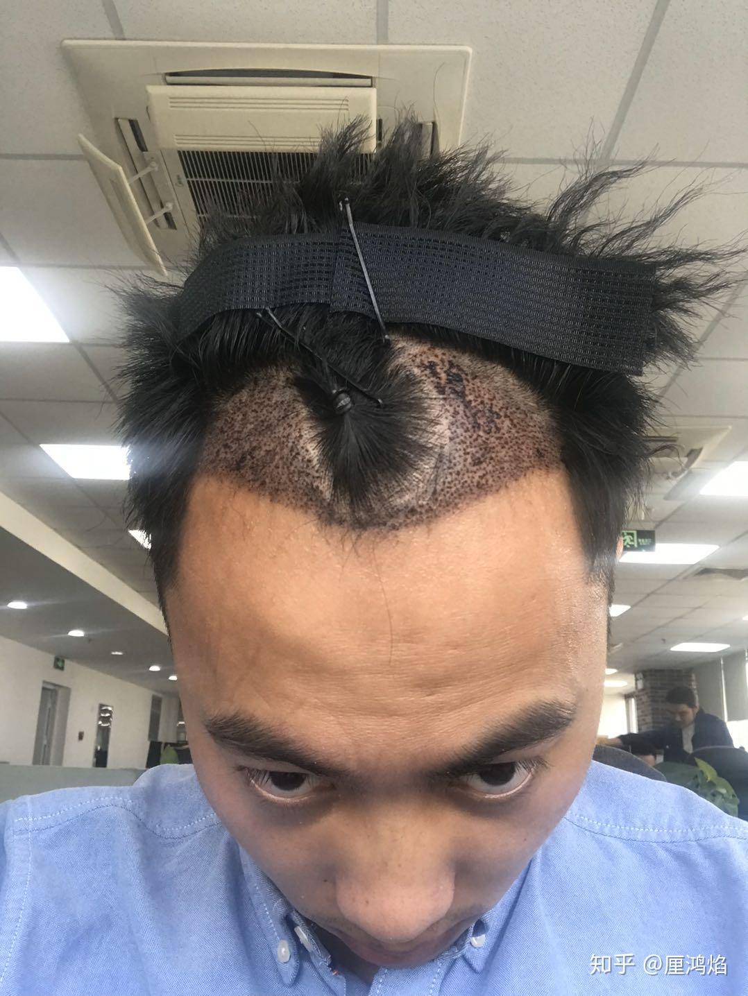 好在术后五天就可以洗头,我洗完头就把头发盖下来了,毫无违和感.