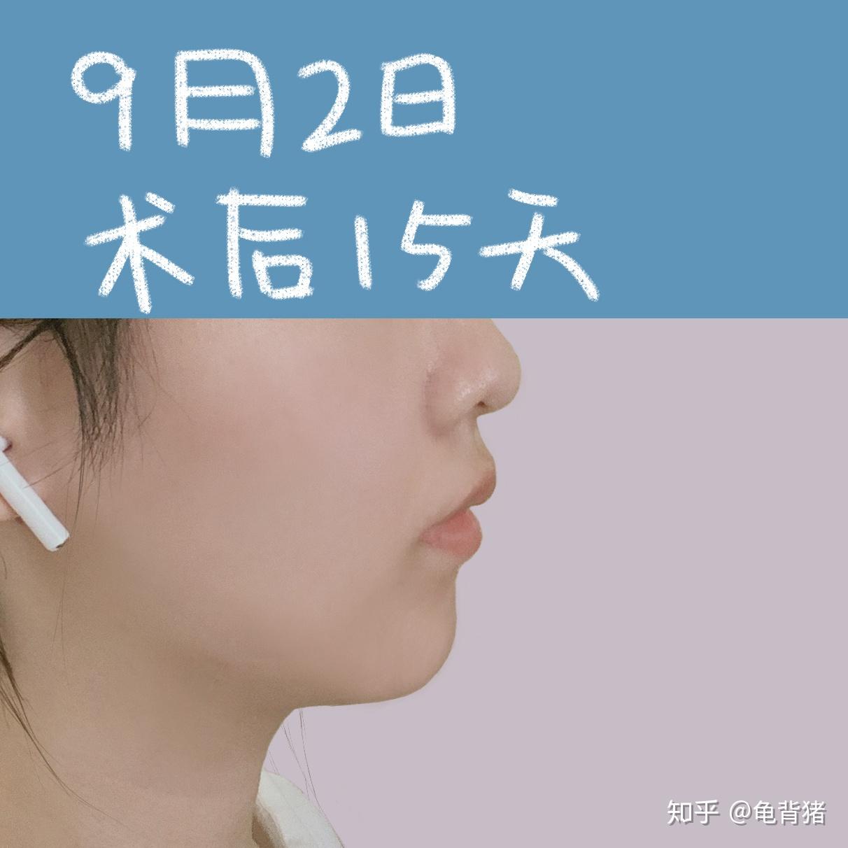 做完颏成型手术两周分享一下我的经历