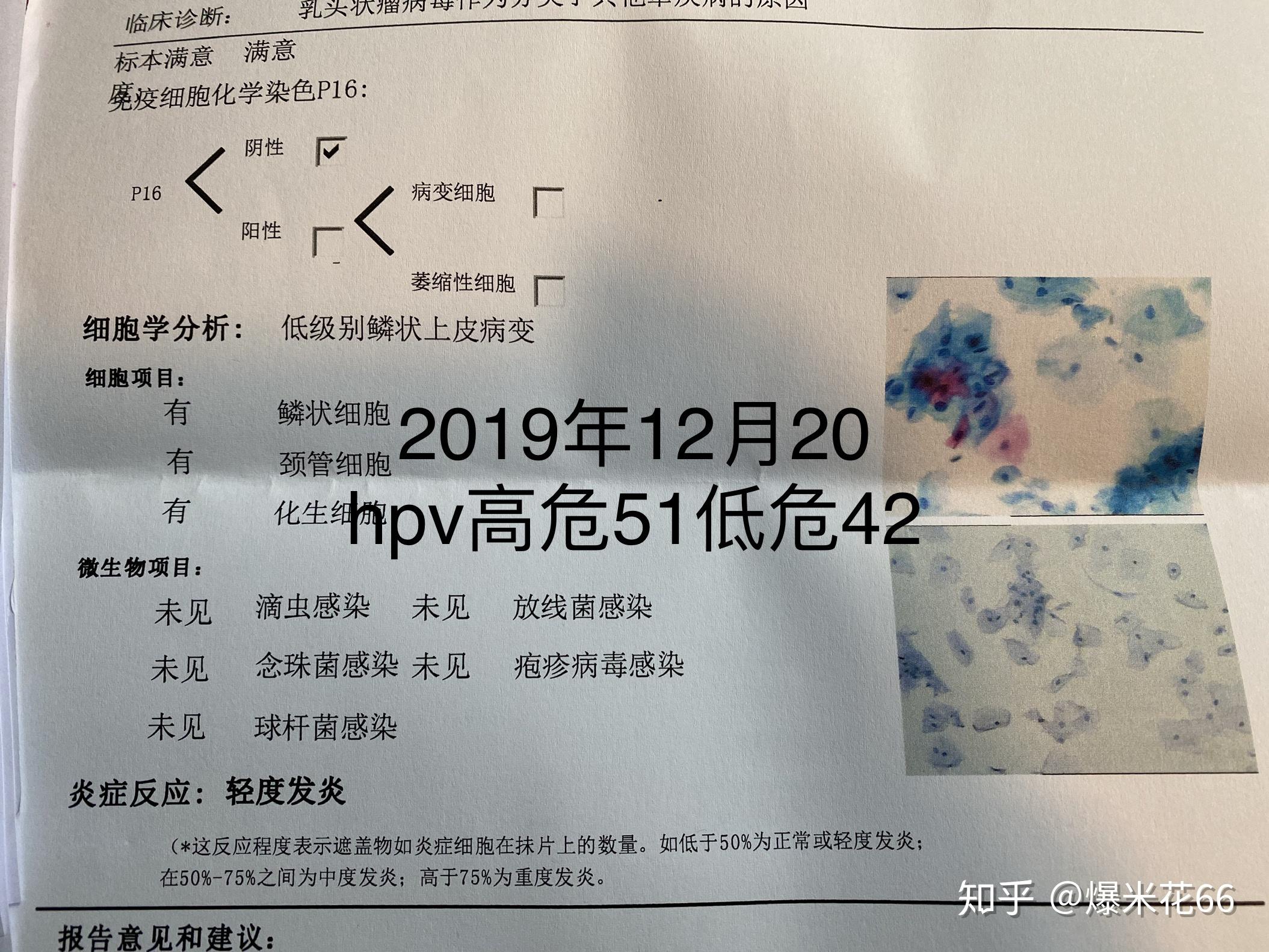 我在三甲醫院治療時(大概2018年1月)就檢查到了我有hpv51高危和42低危