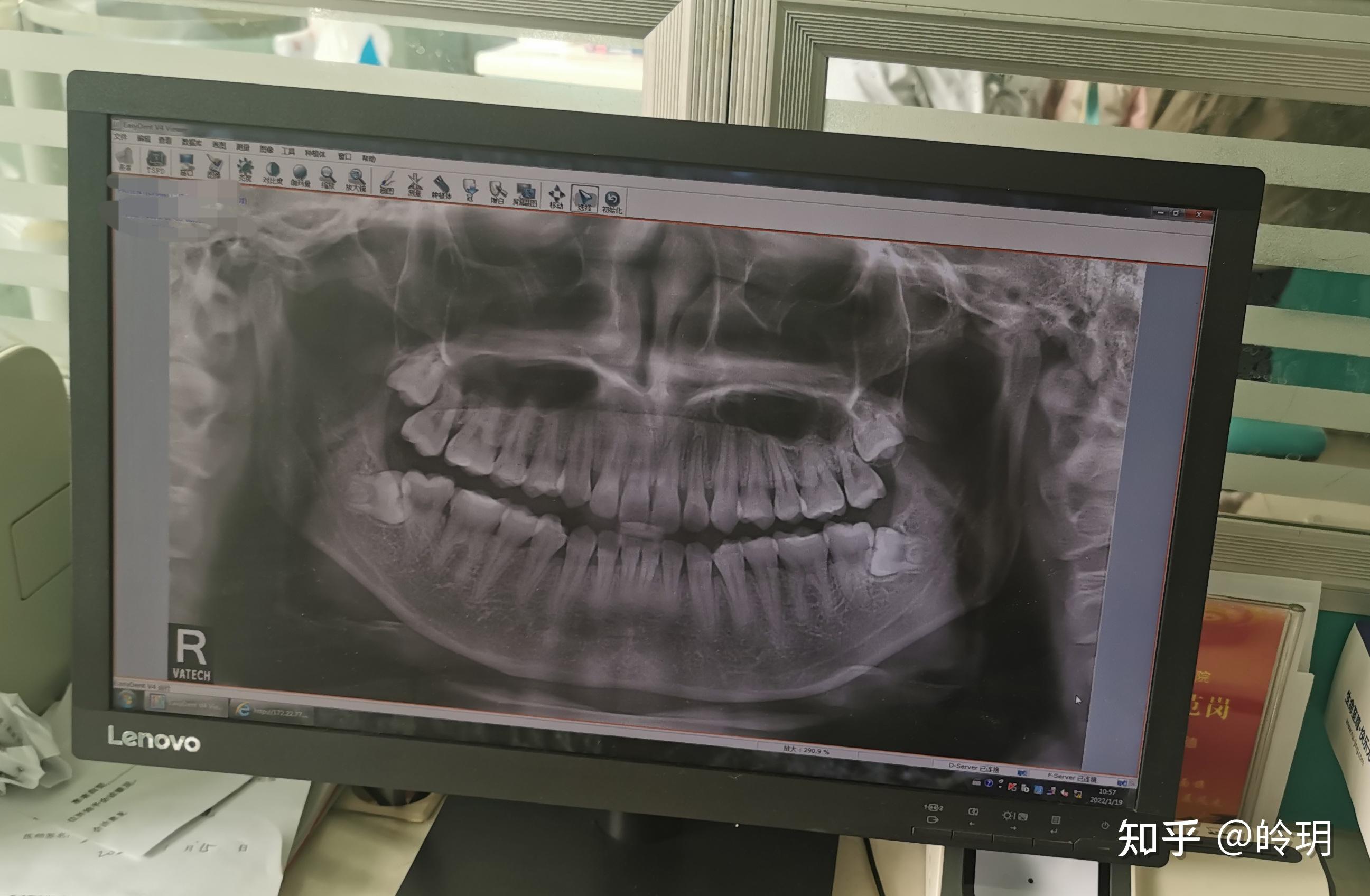 拔除水平阻生智齿历程术后记录