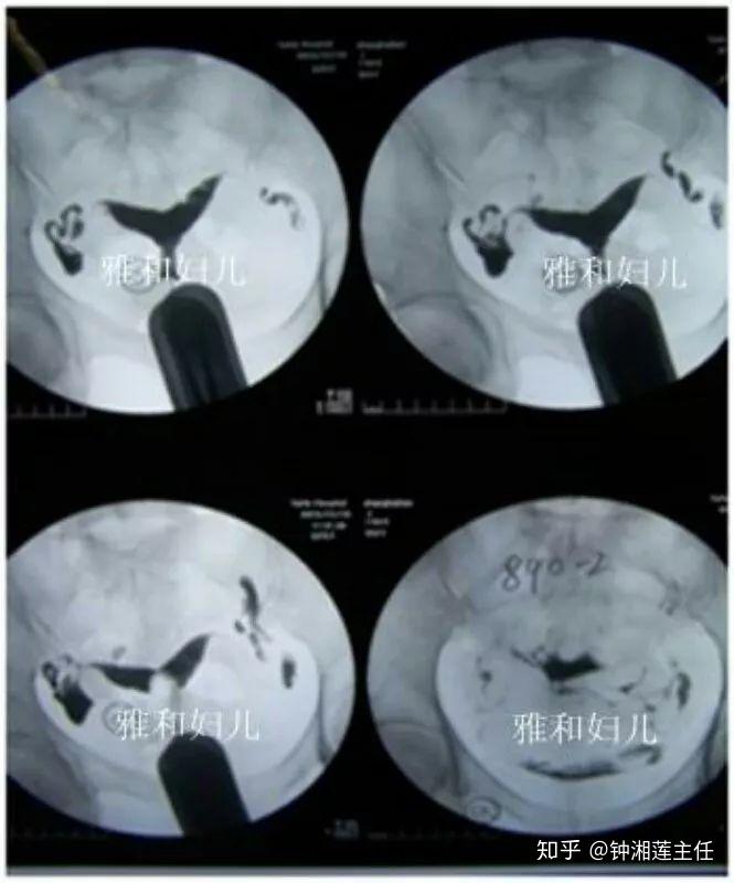 縱膈子宮有懷孕後足月生產的案例,但總歸還是影響的多於特例,鍾主任給