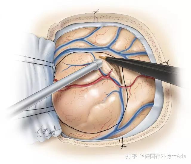 低级别胶质瘤手术治疗策略
