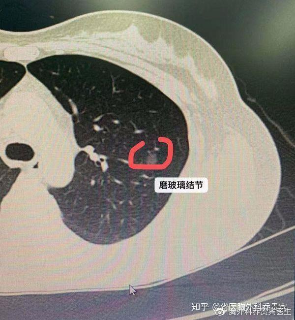 比如说成分叶状生长的结节,有毛刺的,边缘不光滑的,厚壁空洞的,有血管