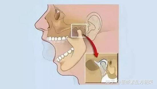 关节弹响 下颚疼痛 家里自检用这几招 知乎