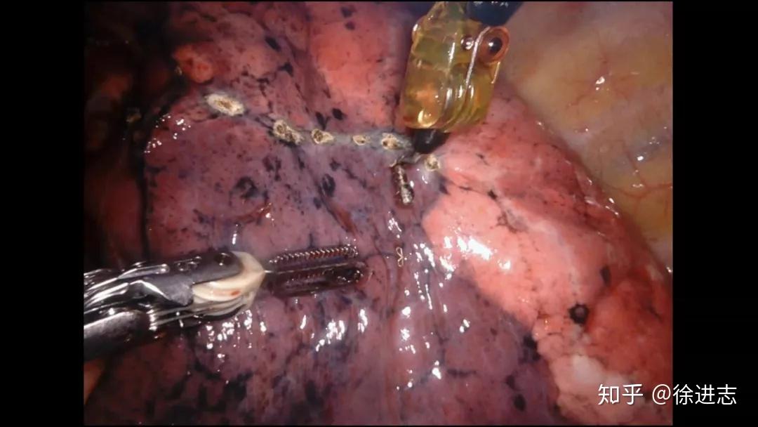 机器人辅助使哈医大四院治疗肺磨玻璃结节彻底进入段时代