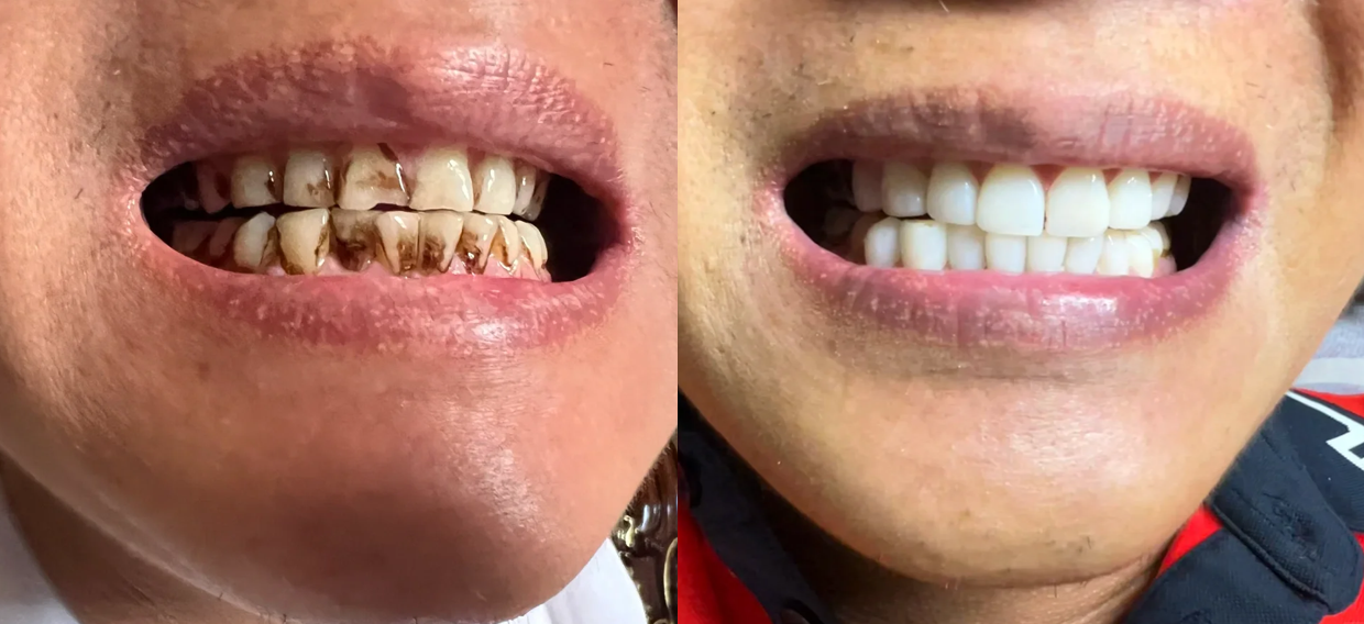 男生抽烟牙黄,牙齿上的黄黑烟渍怎么在1个月内去除?