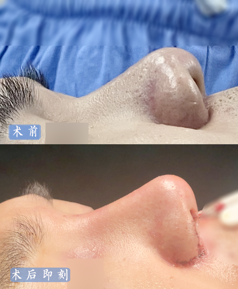 男生隆鼻案例记我在修志夫整形做鼻综合的一次经历