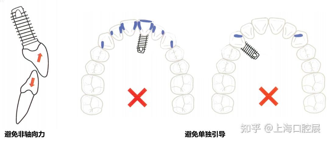 區別於天然牙的調牙合種植單冠的調牙合你瞭解多少