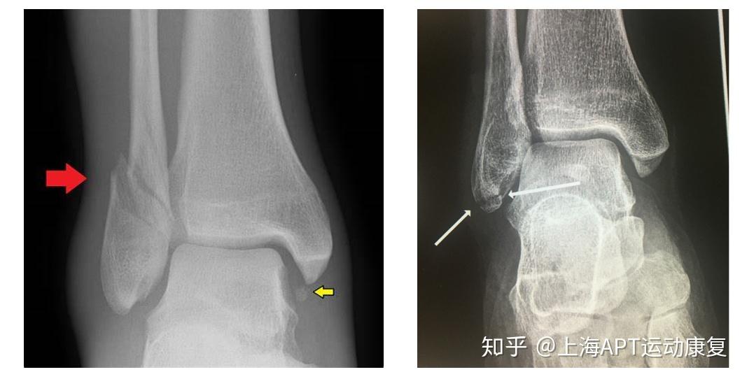 康复案例脚踝扭伤撕脱性骨折20天恢复正常行走