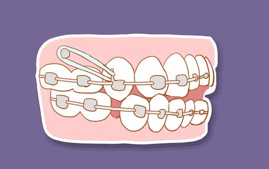 牙齿矫正戴牙套隐形牙套和金属牙套哪个好一点都需要打骨钉吗