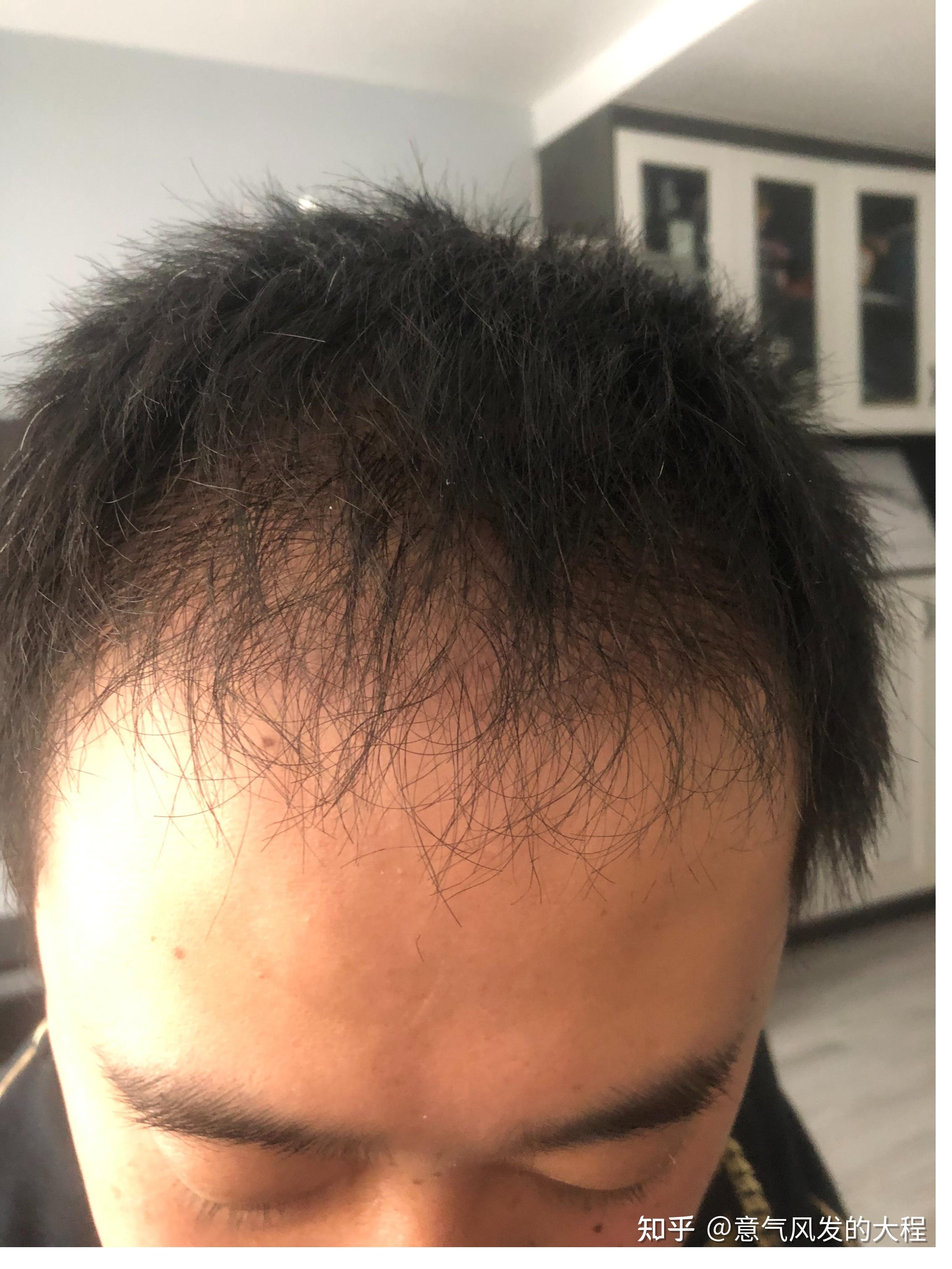 亲身经历讲讲植发恢复期的4个阶段 - 知乎