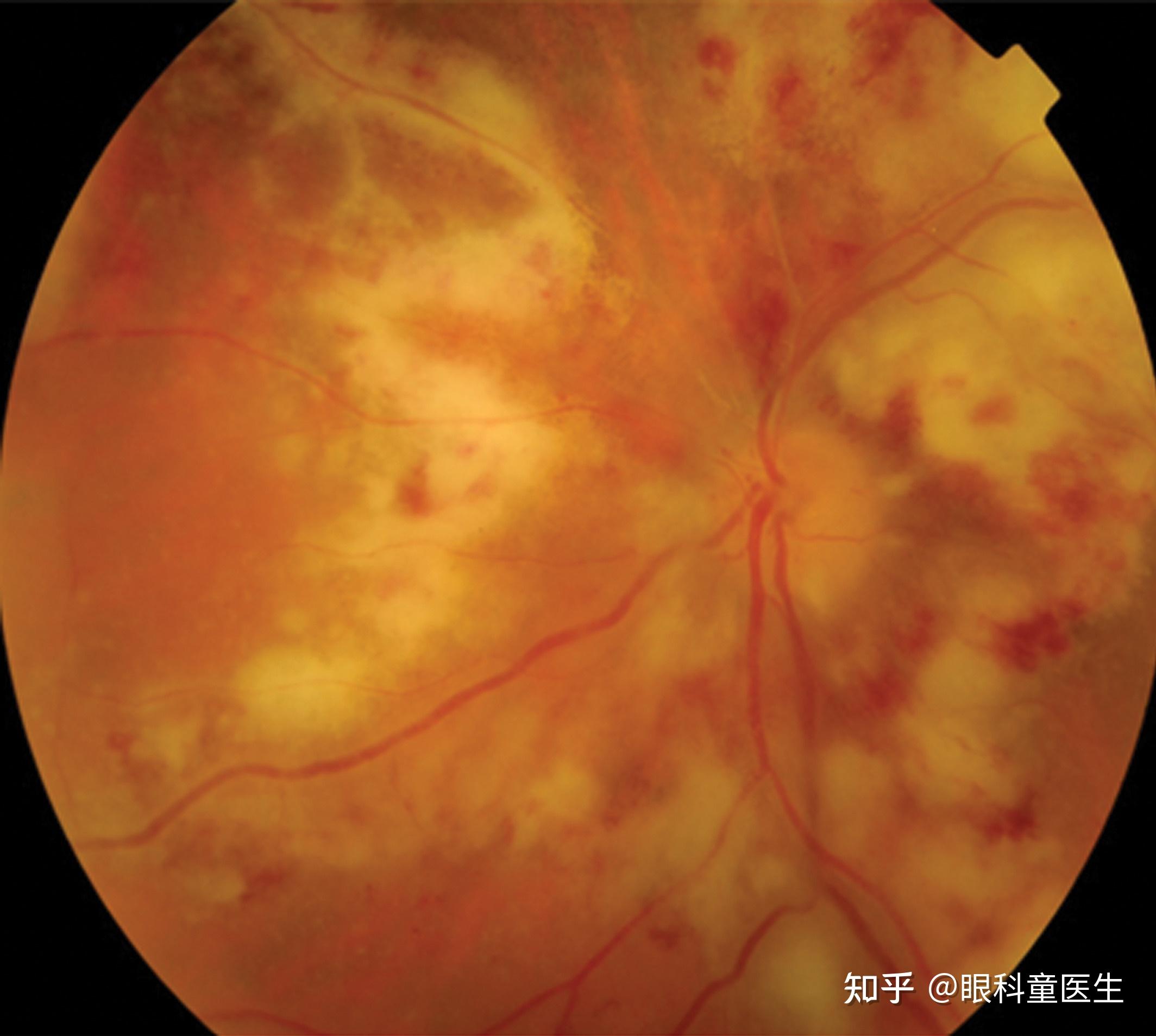 一、巨细胞性视网膜炎-感染性病-医学