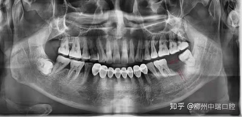 经检查后发现:黄先生左下后牙牙(37