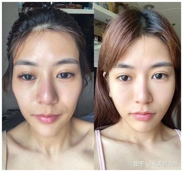 太阳穴凹陷严重,想改善,有什么好的填充方式吗?