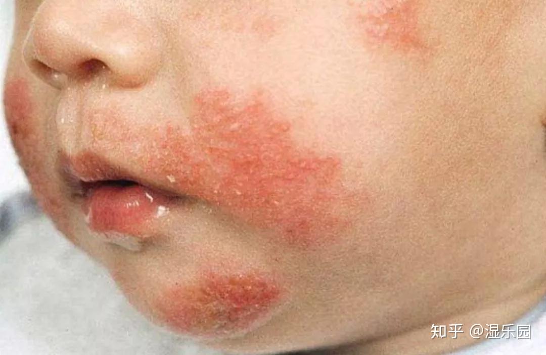 宝宝湿疹症状图片特征图片