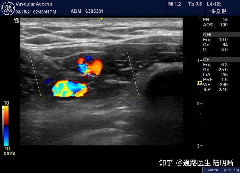 头静脉弓双干变异的超声表现