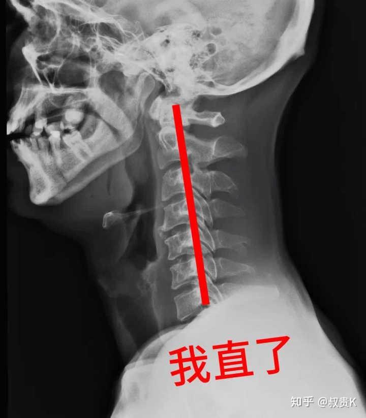 现代人都变得有头部前倾的的倾向了吗?应如何预防? 4 v2 26437eccac4b0c09287ad7844c378930 720w