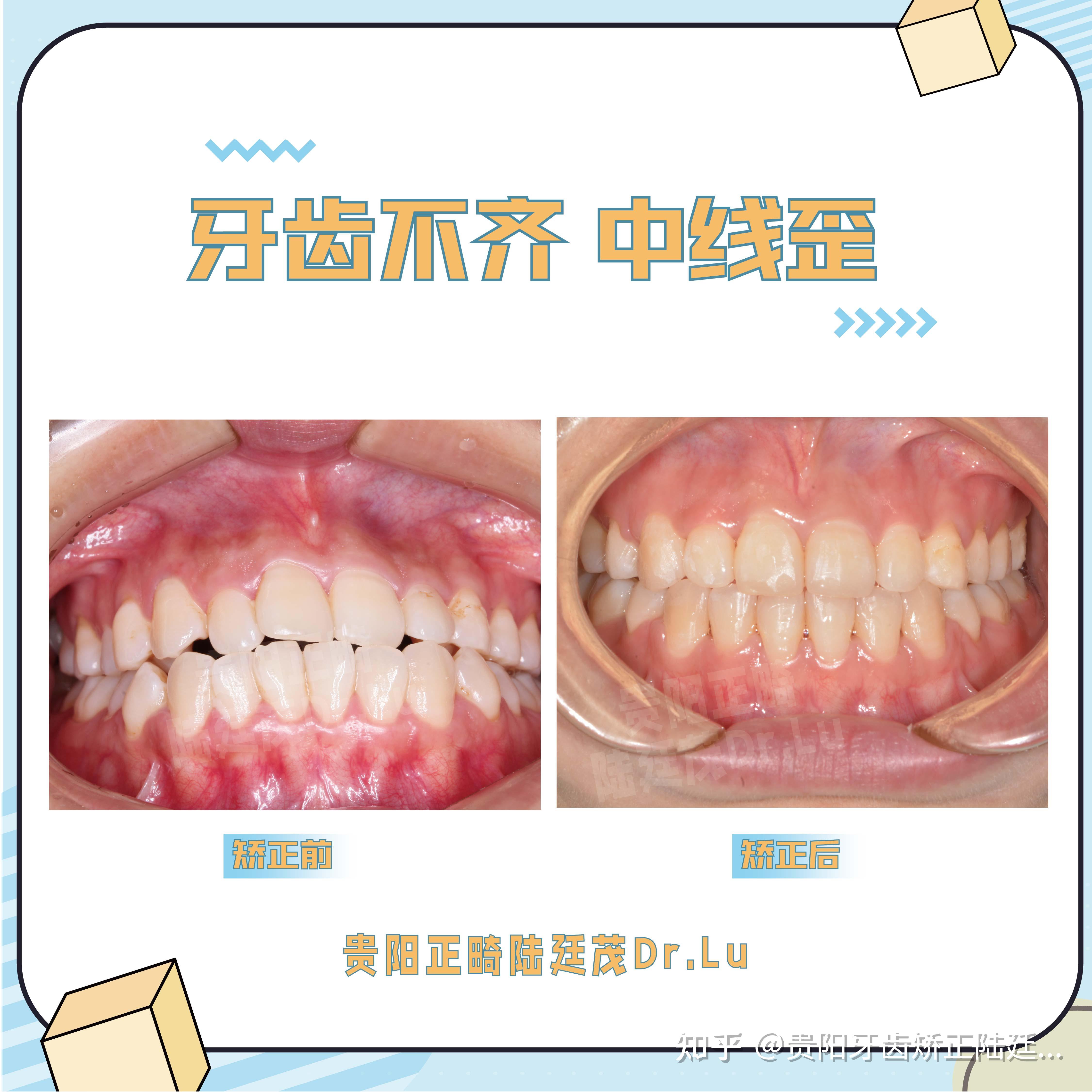 貴陽牙齒矯正正畸後中線對齊笑容立刻滿分