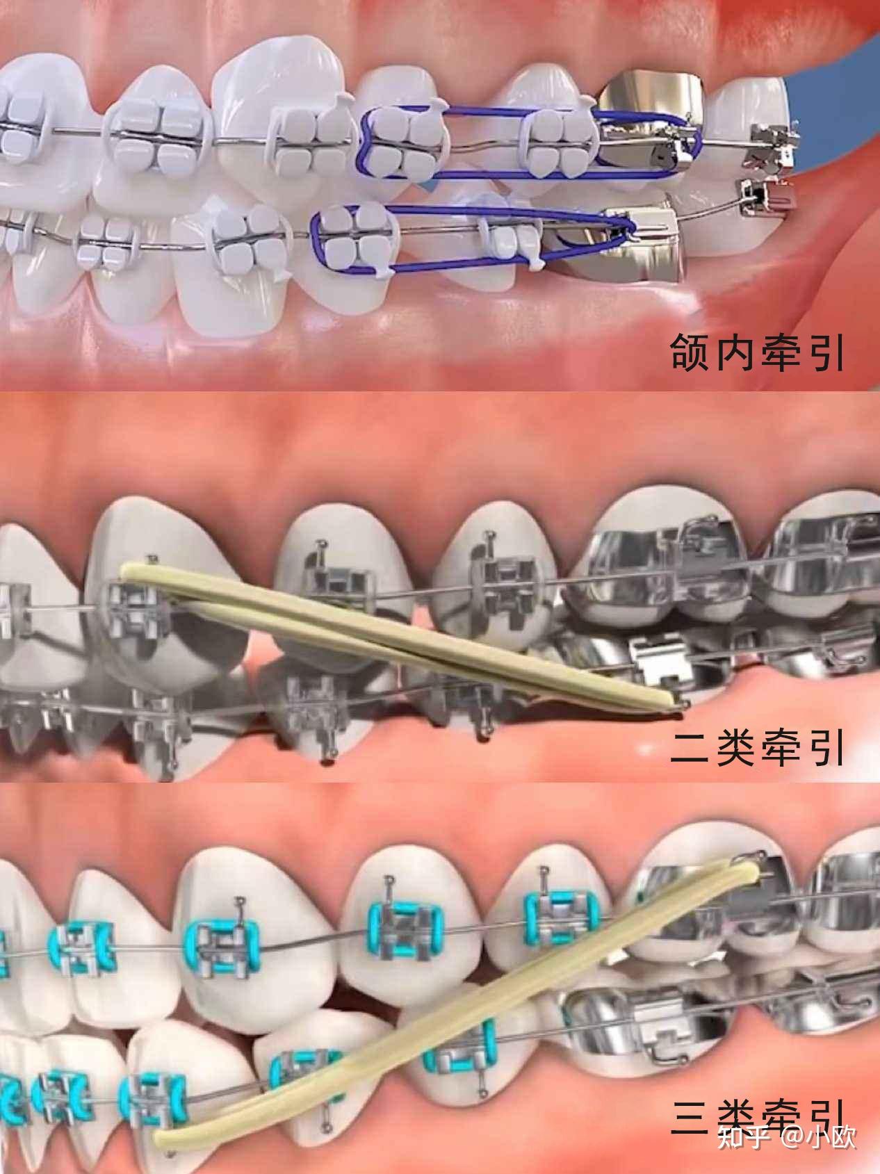 矫正牙齿皮筋图解图片