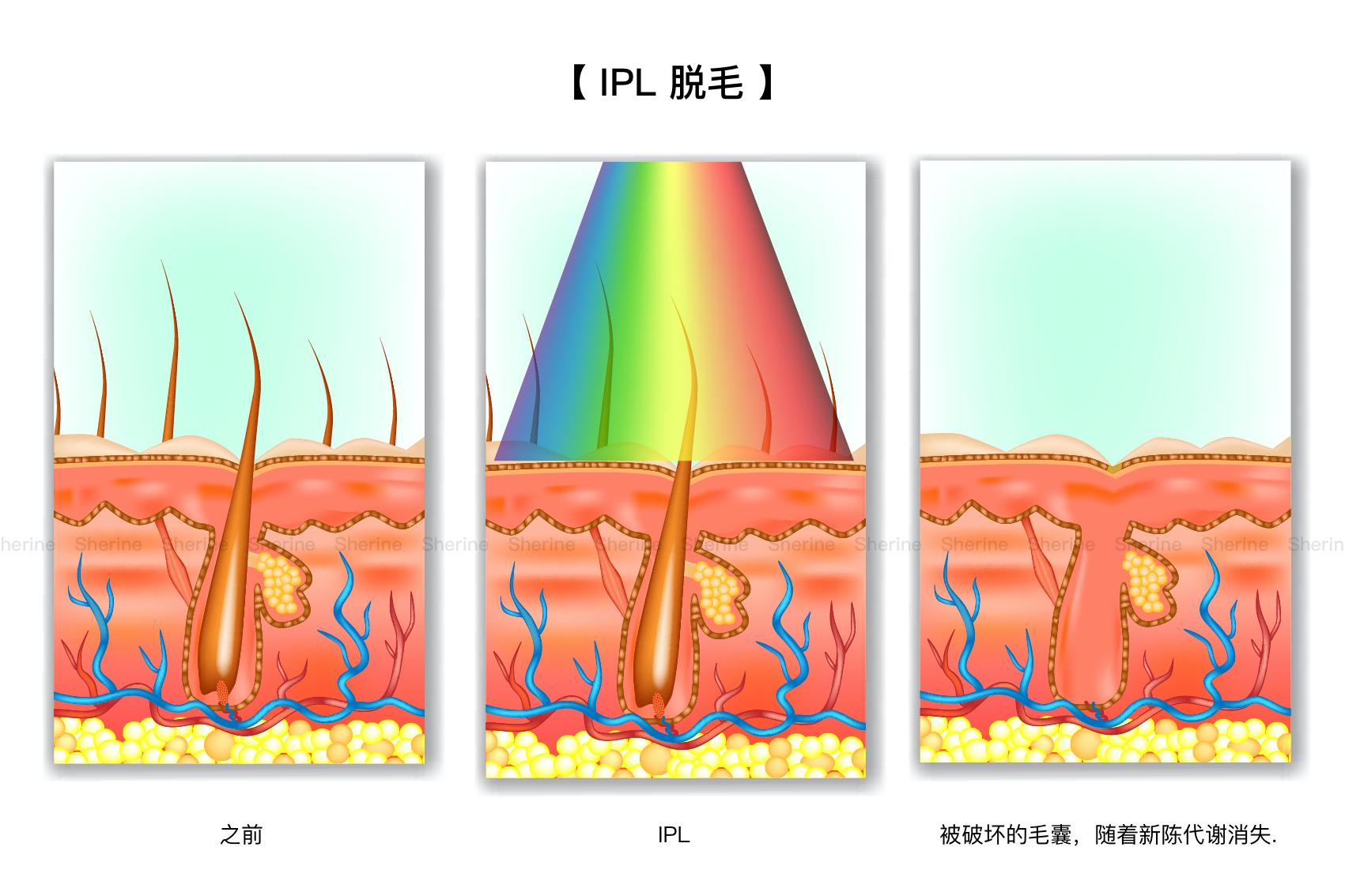 一篇文章了解激光脱毛ipl脱毛冰点脱毛其他各种脱毛方法