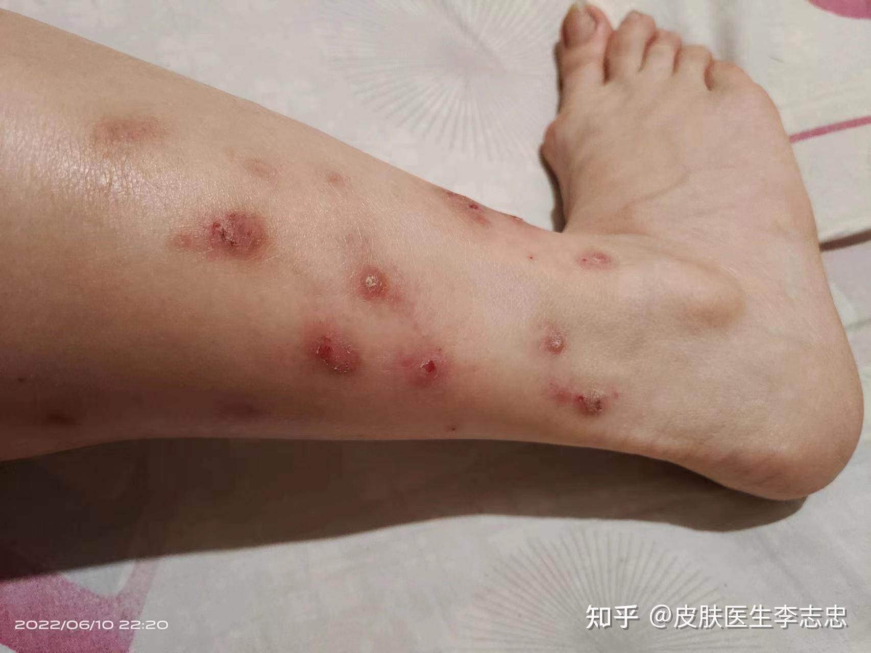 什么是结节性痒疹？中医如何认识和治疗结节性痒疹？ - 知乎