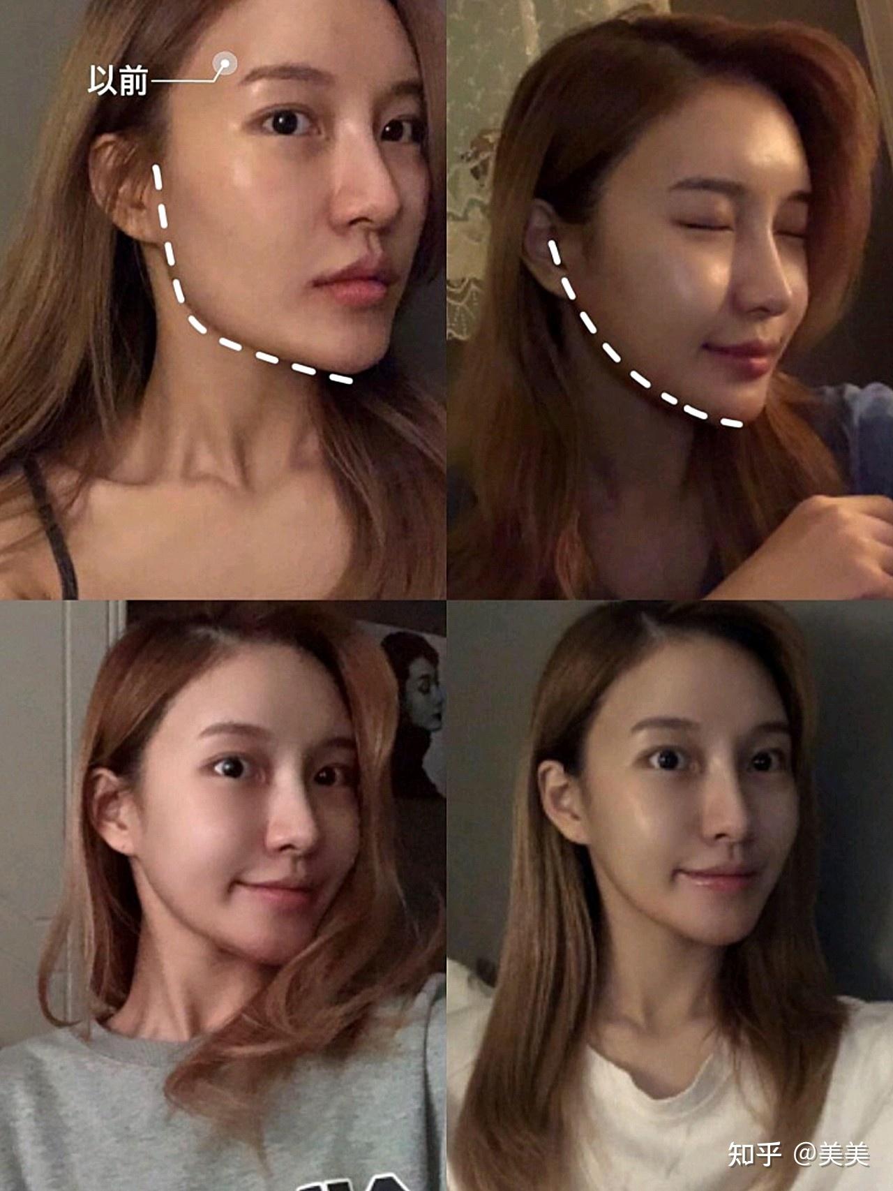 下颌角是影响下半张脸的关键,医学上公认最完美的下颌角曲线是一个120