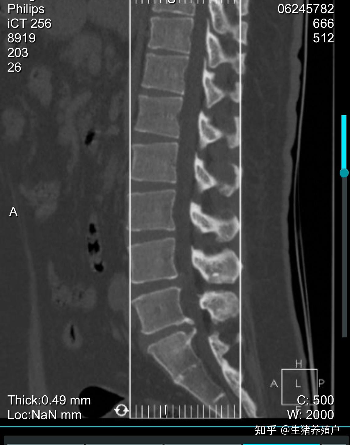 29岁腰椎间盘L4L5S1突出，后纵韧带钙化，骨质增生等腰椎问题， - 知乎