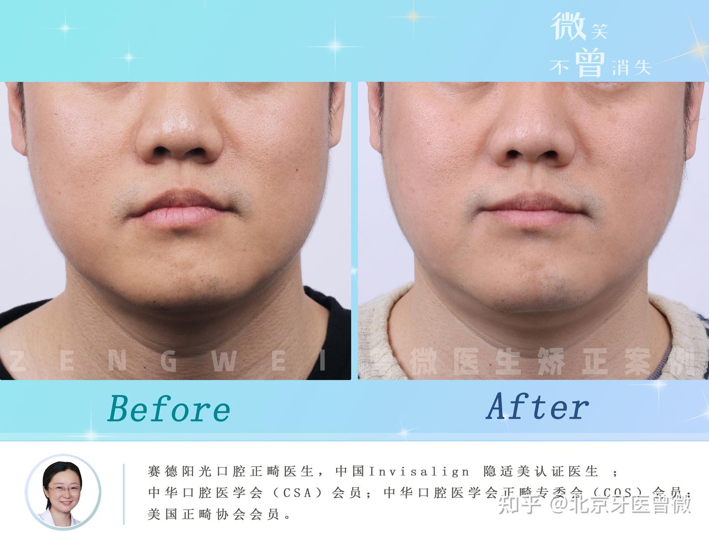 上颌发育不足导致的地包天面型 - 知乎